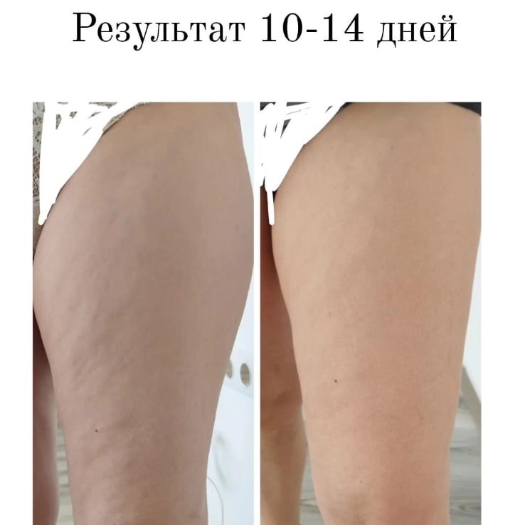 Лимфодренажный лосьон для тела